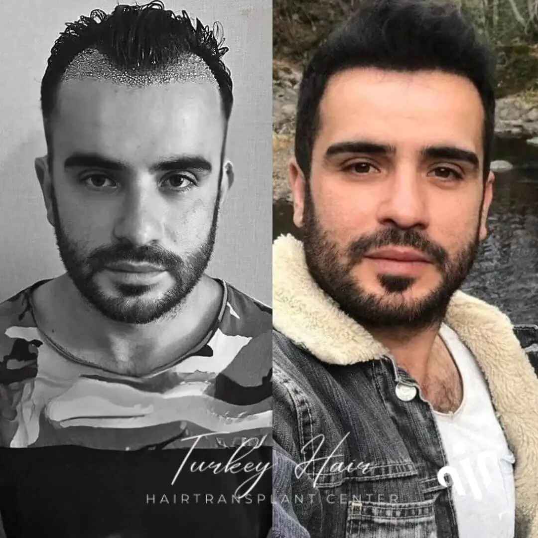 1000-Grafts-Hair-Transplant-Before-After-2.Jpg 1000 Grafts Hair Transplant In Turkey – Cost – Before And After Hair Restoration Excellence You Can Trust