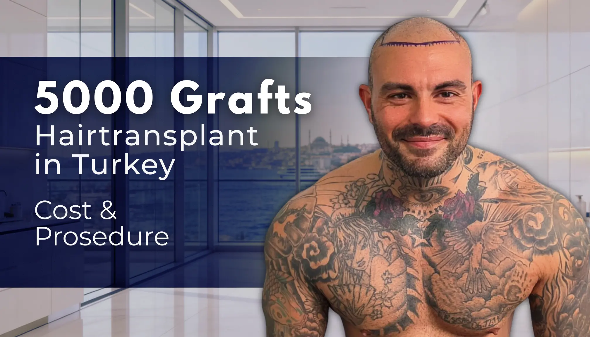 5000 Grafts Hair Transplant Turkey – Cost – Before And After 1 5000 Grafts Hair Transplant Turkey – Cost – Before And After Hair Restoration Excellence You Can Trust