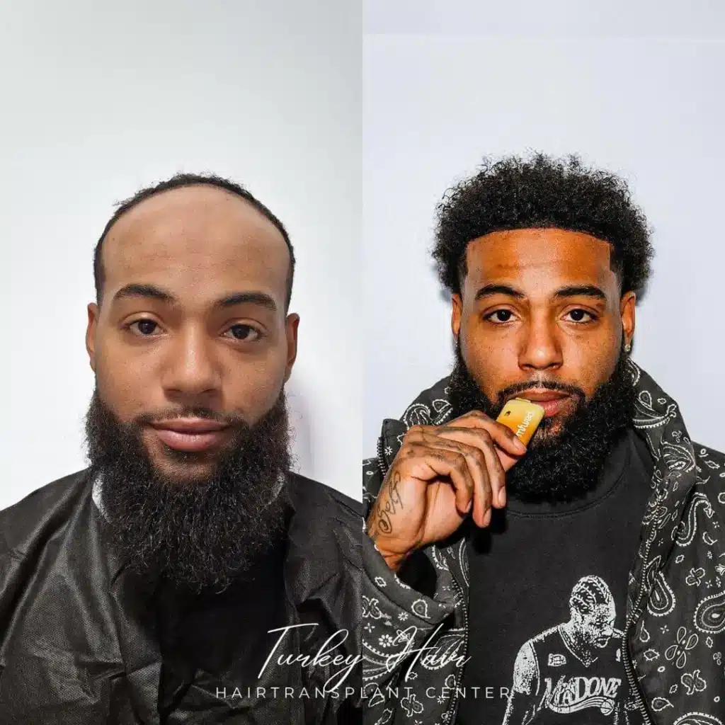 5000-Grafts-Hair-Transplant-Before-After-1.Jpg 5000 Grafts Hair Transplant Turkey – Cost – Before And After Hair Restoration Excellence You Can Trust