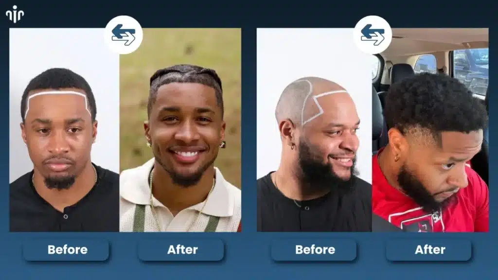 Before-And-After-Hairstyle-Comparisons-1280X720 Top Men’s Hairstyles That Suit Receding Or Balding Hairlines Hair Restoration Excellence You Can Trust