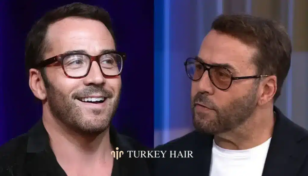 Crown-Area-And-Overall-Density-Changes-1344X768 Jeremy Piven Hair Transplant – Before And After Hair Restoration Excellence You Can Trust