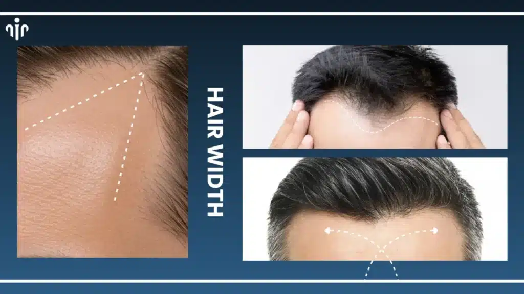 Haircuts-By-Hairline-Type-1280X720 Top Men’s Hairstyles That Suit Receding Or Balding Hairlines Hair Restoration Excellence You Can Trust