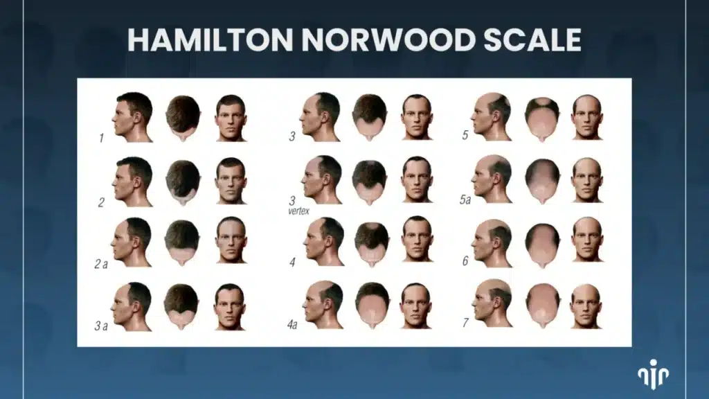 Hairstyles-For-Advanced-Hair-Loss-1280X720 Top Men’s Hairstyles That Suit Receding Or Balding Hairlines Hair Restoration Excellence You Can Trust