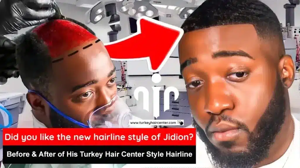 Img_5614-1.Jpg Rumors About Jidion Hair Transplant Before And After Hair Restoration Excellence You Can Trust