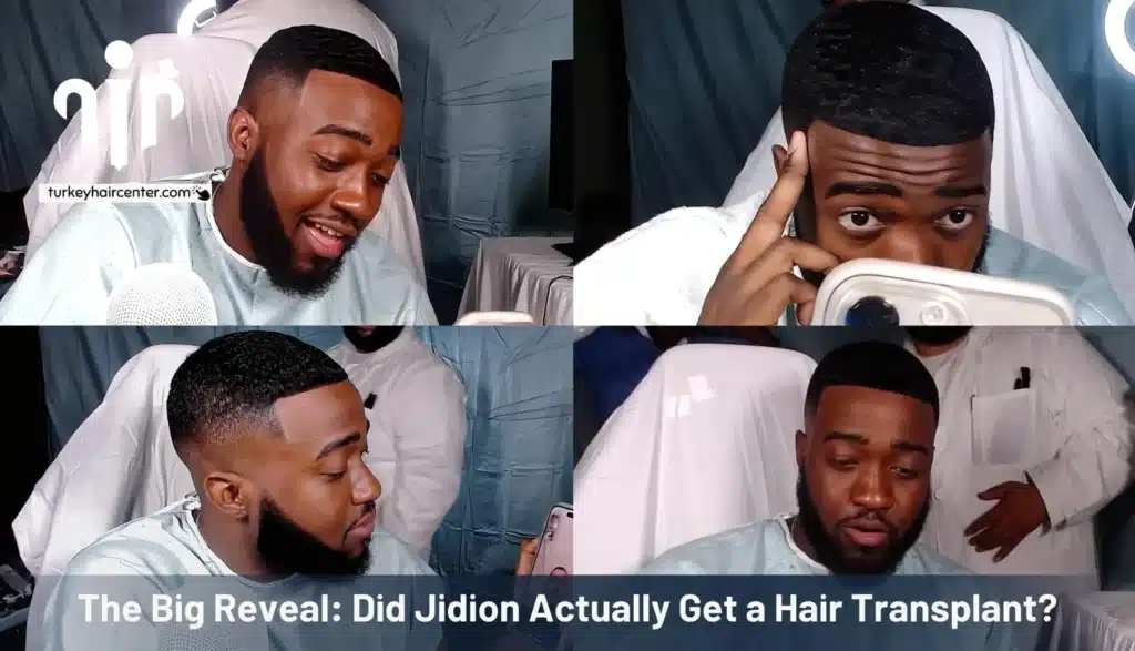 Jidion-Adams-Hairline-1024X587 Rumors About Jidion Hair Transplant Before And After Hair Restoration Excellence You Can Trust