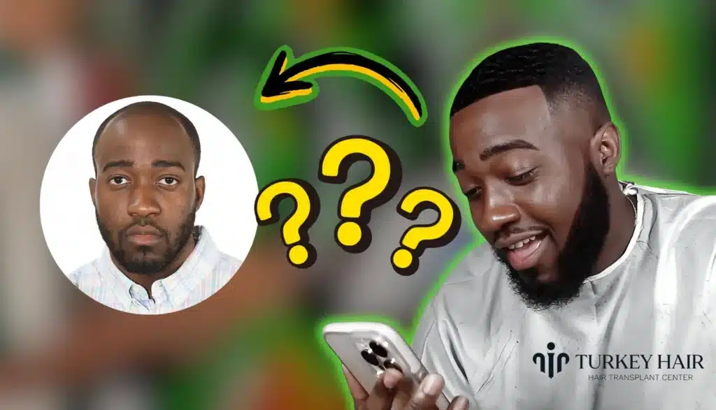 Jidion-Hair-Transplant-Before-After-1024X587 Rumors About Jidion Hair Transplant Before And After Hair Restoration Excellence You Can Trust