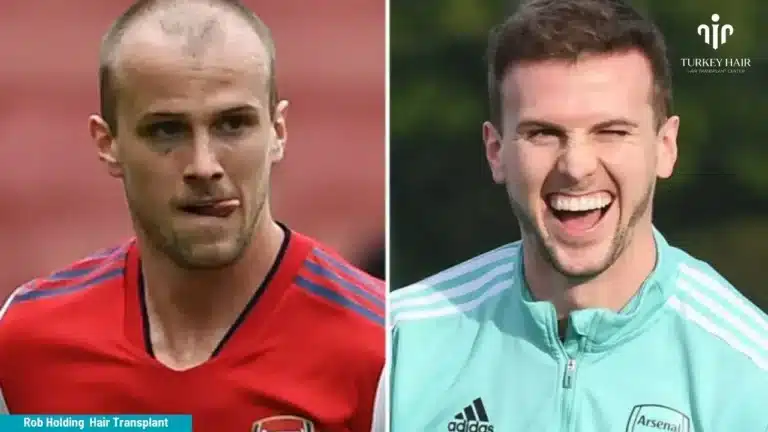 Rob-Holding-Hair-Transplant-1-1-768X432 Rob Holding Hair Transplant Hair Restoration Excellence You Can Trust