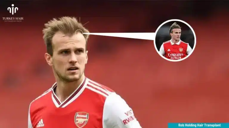 Rob-Holding-Hair-Transplant-2-1-768X432 Rob Holding Hair Transplant Hair Restoration Excellence You Can Trust