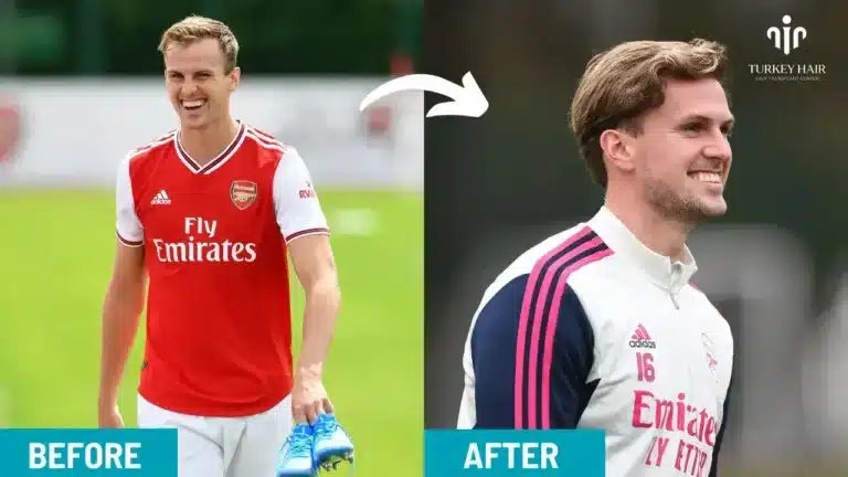Rob-Holding-Hair-Transplant-5-1-768X432 Rob Holding Hair Transplant Hair Restoration Excellence You Can Trust
