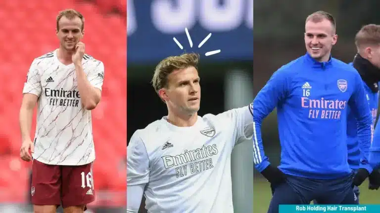 Rob-Holding-Hair-Transplant-6-1-768X432 Rob Holding Hair Transplant Hair Restoration Excellence You Can Trust