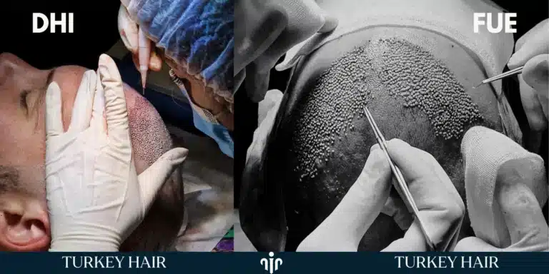 Techniques-Used-For-Widows-Peak-768X384 Widow’s Peak Hair Transplant In Turkey – Cost- Before And After Hair Restoration Excellence You Can Trust