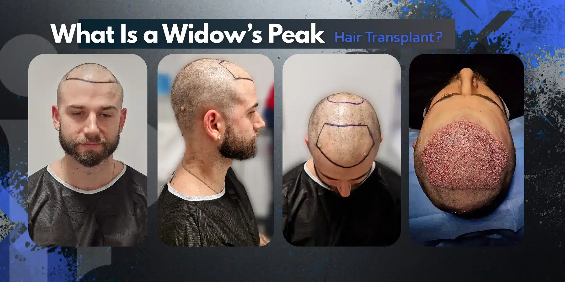 Widow’s Peak Hair Transplant In Turkey – Cost- Before And After 1 Widow’s Peak Hair Transplant In Turkey – Cost- Before And After Hair Restoration Excellence You Can Trust