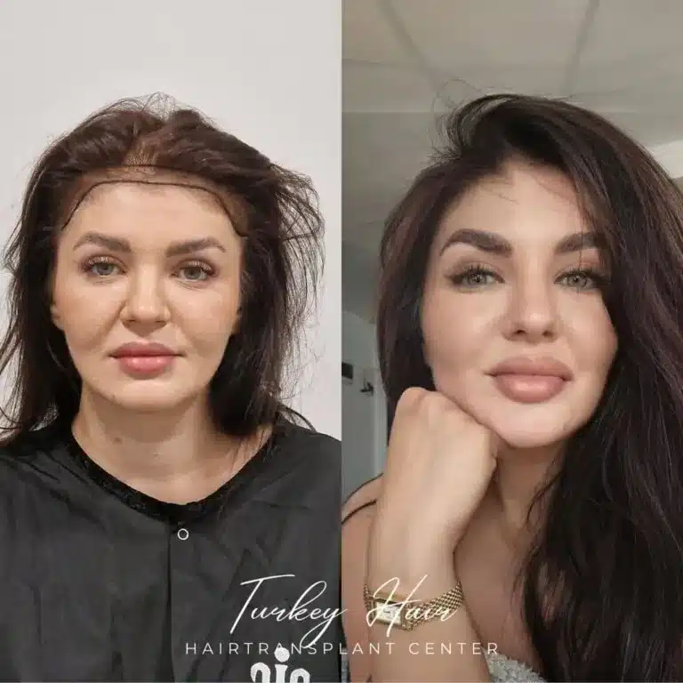 Women-1000-Grafts-Hair-Transplant-Before-After-768X768.Jpg 1000 Grafts Hair Transplant In Turkey – Cost – Before And After Hair Restoration Excellence You Can Trust