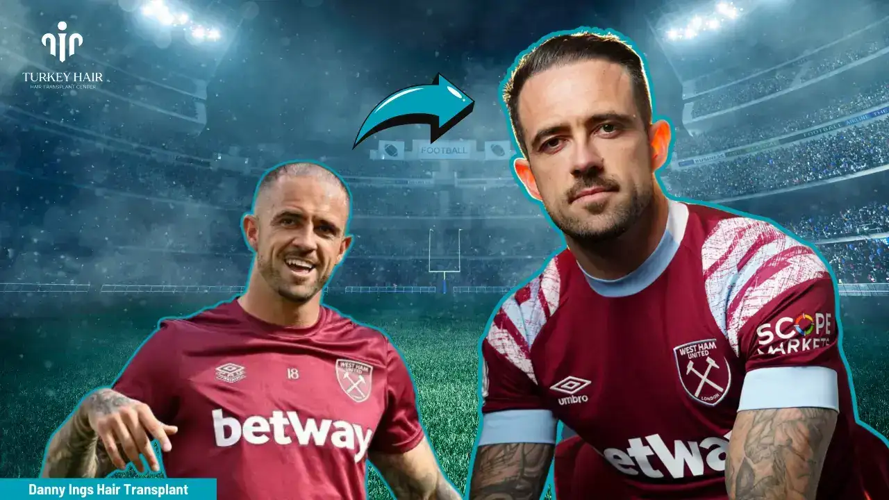 Let’s Discover Succesfull Striker Danny Ings’ Hair Transplant 2026 1 Let’s Discover Succesfull Striker Danny Ings’ Hair Transplant 2026 Hair Restoration Excellence You Can Trust