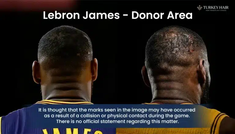 Lebron James Donor Area