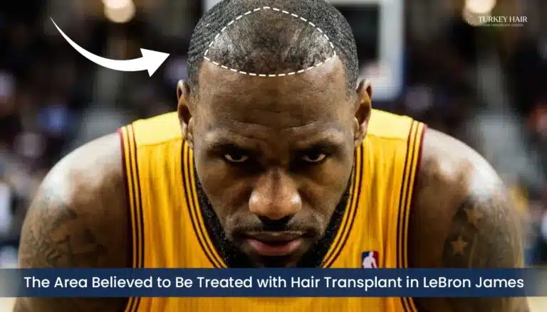 Lebron James Hairline Restoration