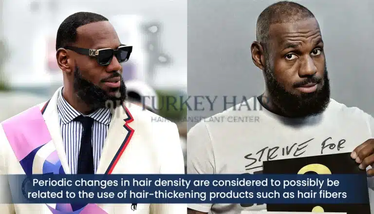 Lebron James Hair Density