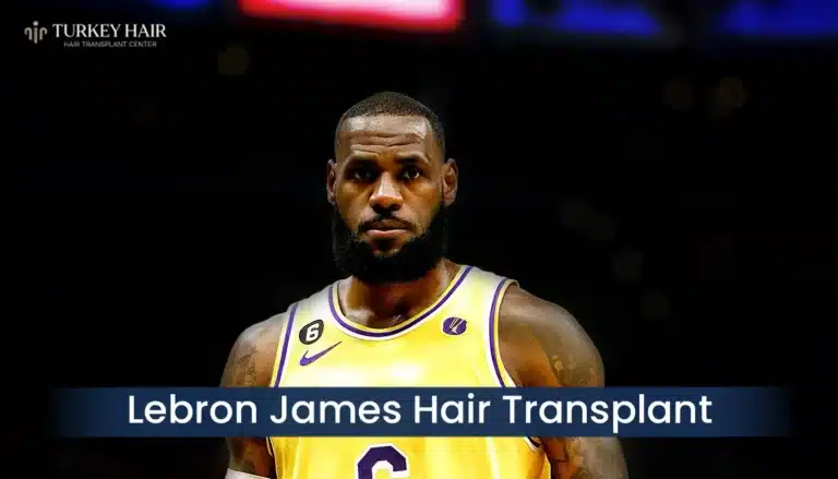 Lebron James Hair Transplant