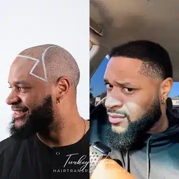 Tyrq.jpg 5000 Grafts Hair Transplant Turkey – Cost – Before And After Hair Restoration Excellence You Can Trust