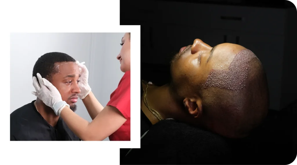 Hair Transplant Before Procedure And During Operation