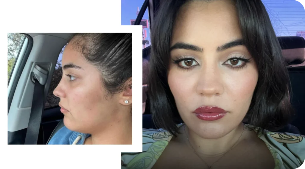 Female Hair Transplant Before And After Results
