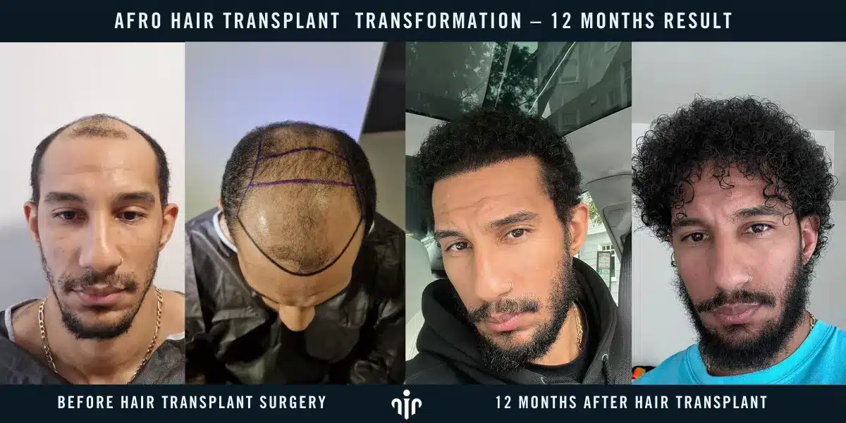 Afro Hair Transplant For Curly &Amp; Coily Hair 8 Final Results Are Typically Visible After 12 Months, With Full Hair Growth And Natural Density Achieved.