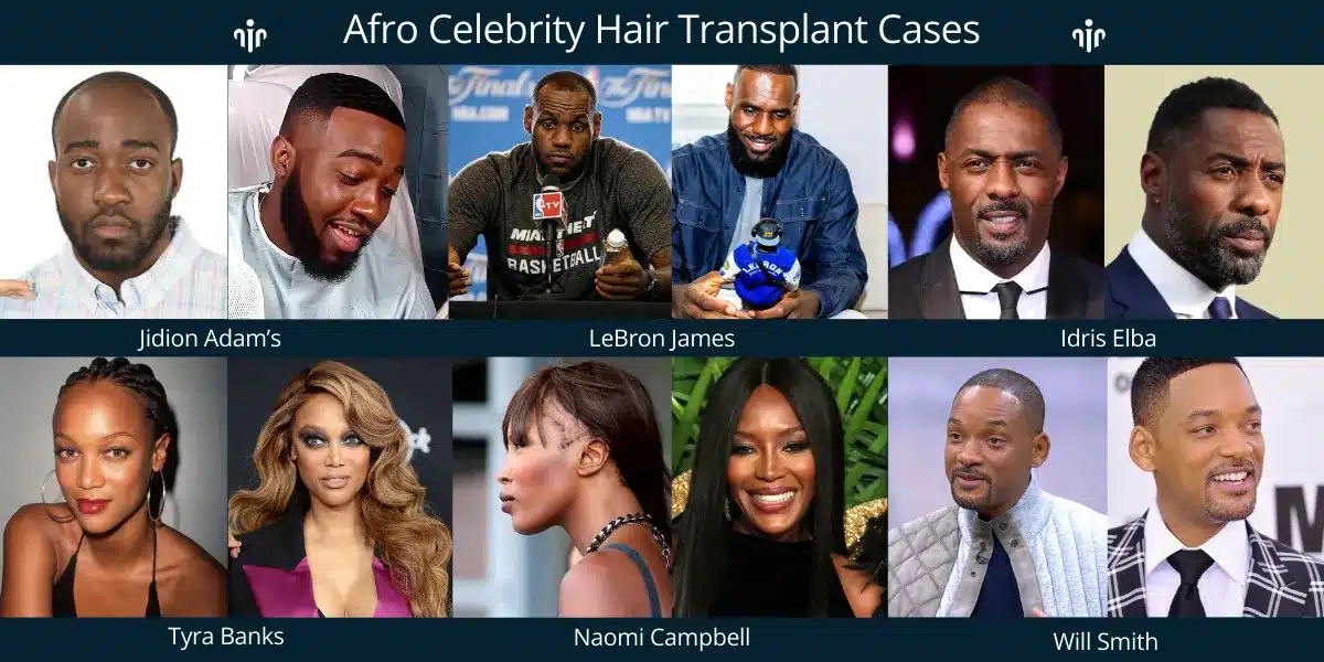 Afro Hair Transplant For Curly &Amp; Coily Hair 12 Afro Celebrity Hair Transplant Results Highlight Natural Hairline Design And Successful Restoration For Curly Hair Types.