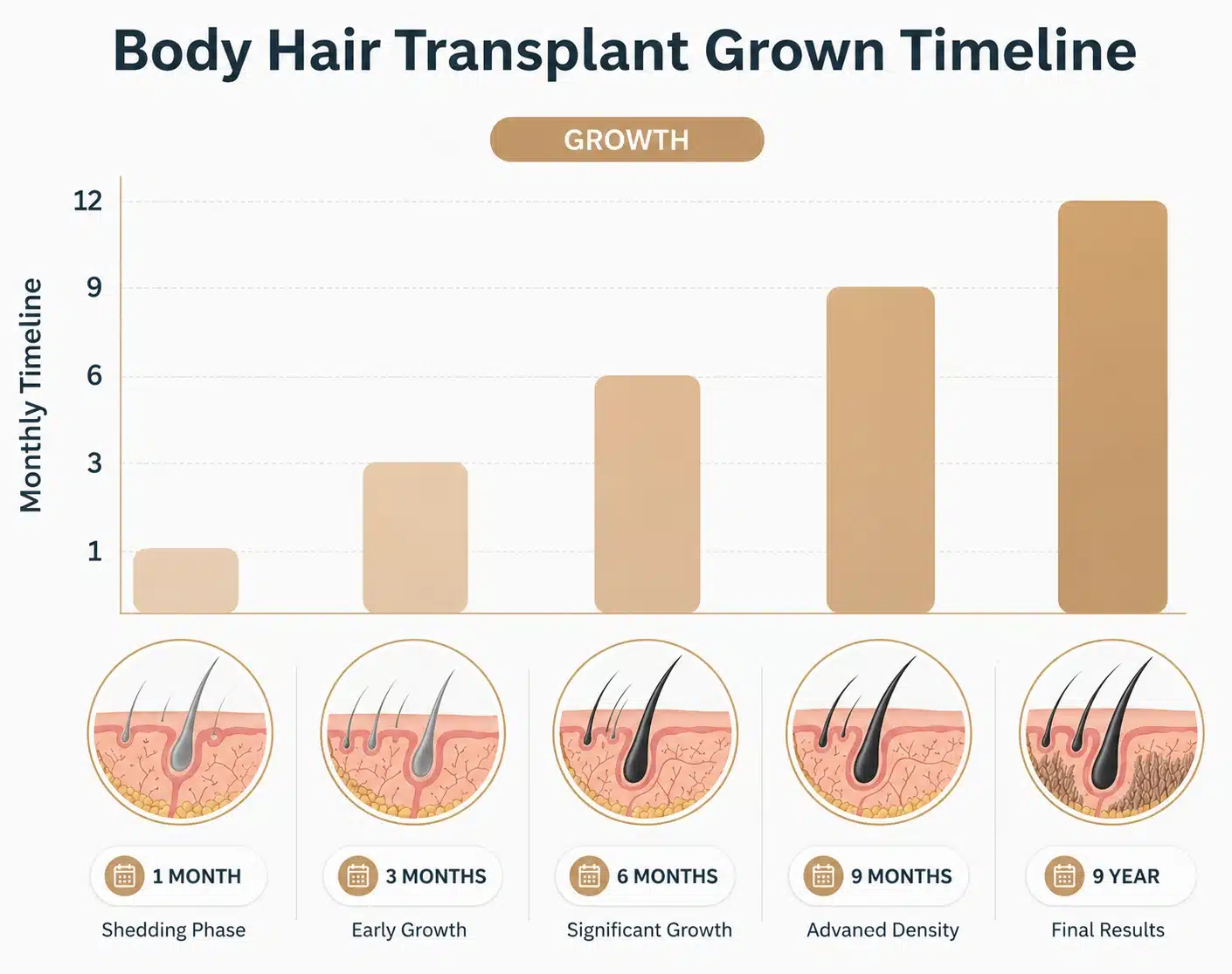 Body Hair Transplant In Turkey: Cost, Procedure &Amp; Before-After Hair Restoration Excellence You Can Trust