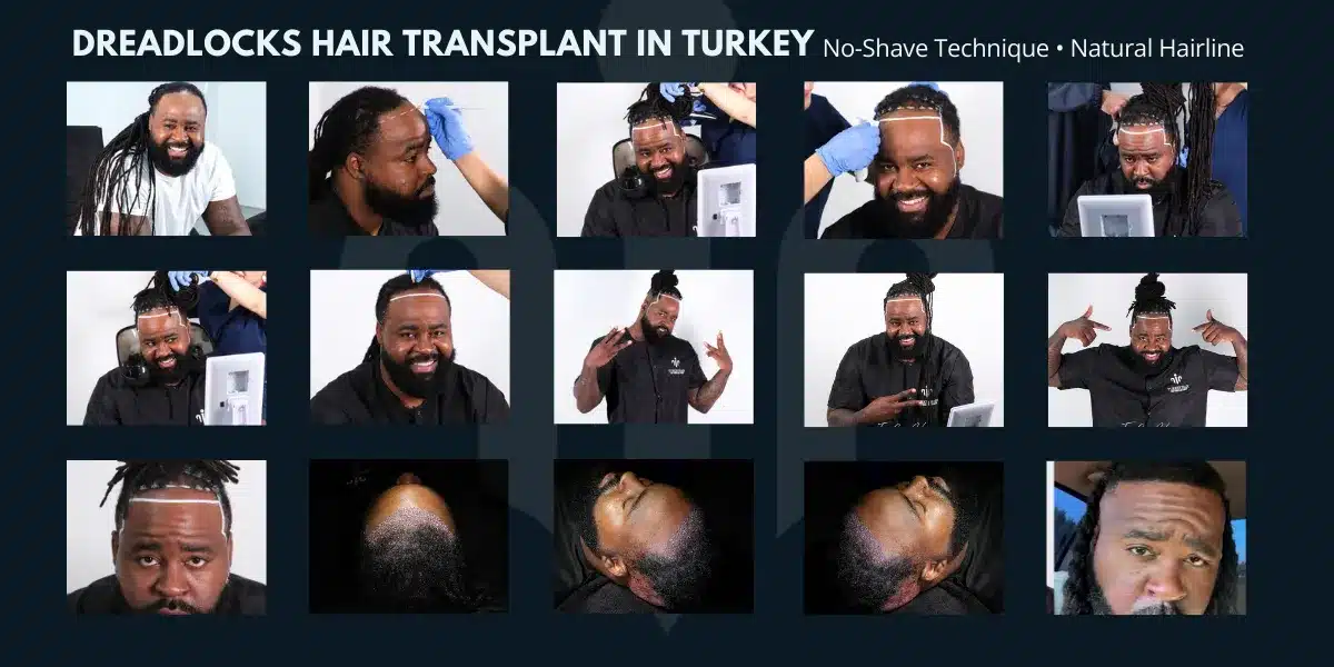 Afro Hair Transplant For Curly &Amp; Coily Hair 11 No Shave Hair Transplant Is A Technique That Allows Hair Transplantation Without Shaving The Donor Or Recipient Area.
