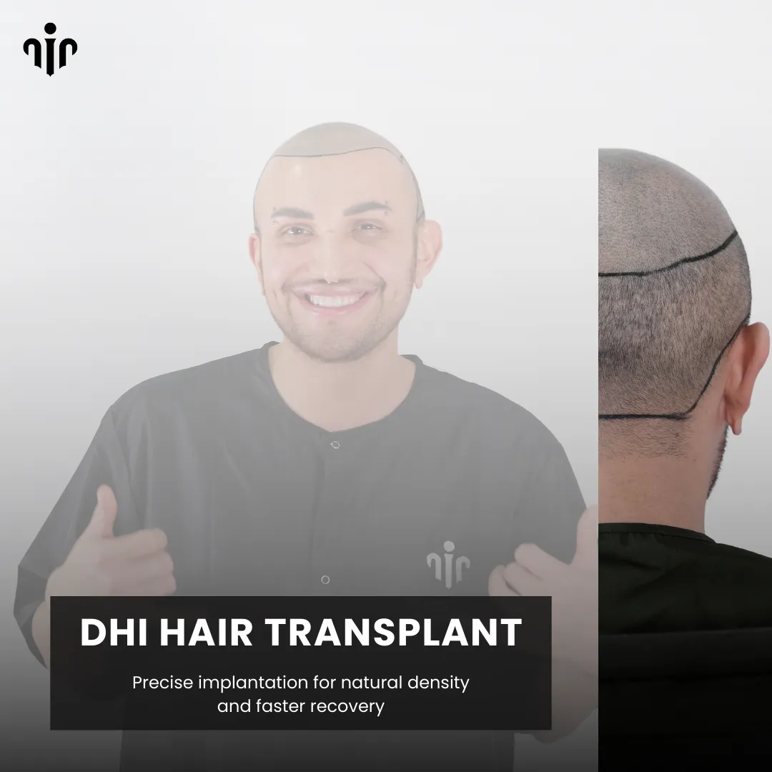 Dhi Hair Transplant 12 Direct Hair Implantation