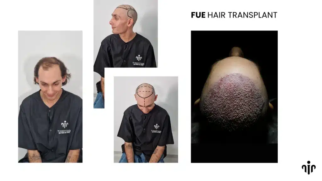 Fue Hair Transplant In Turkey – Cost, Before &Amp; After 15 Fue Hair Transplant Is A Modern Technique Where Individual Hair Follicles Are Extracted And Implanted For Natural-Looking Results.
