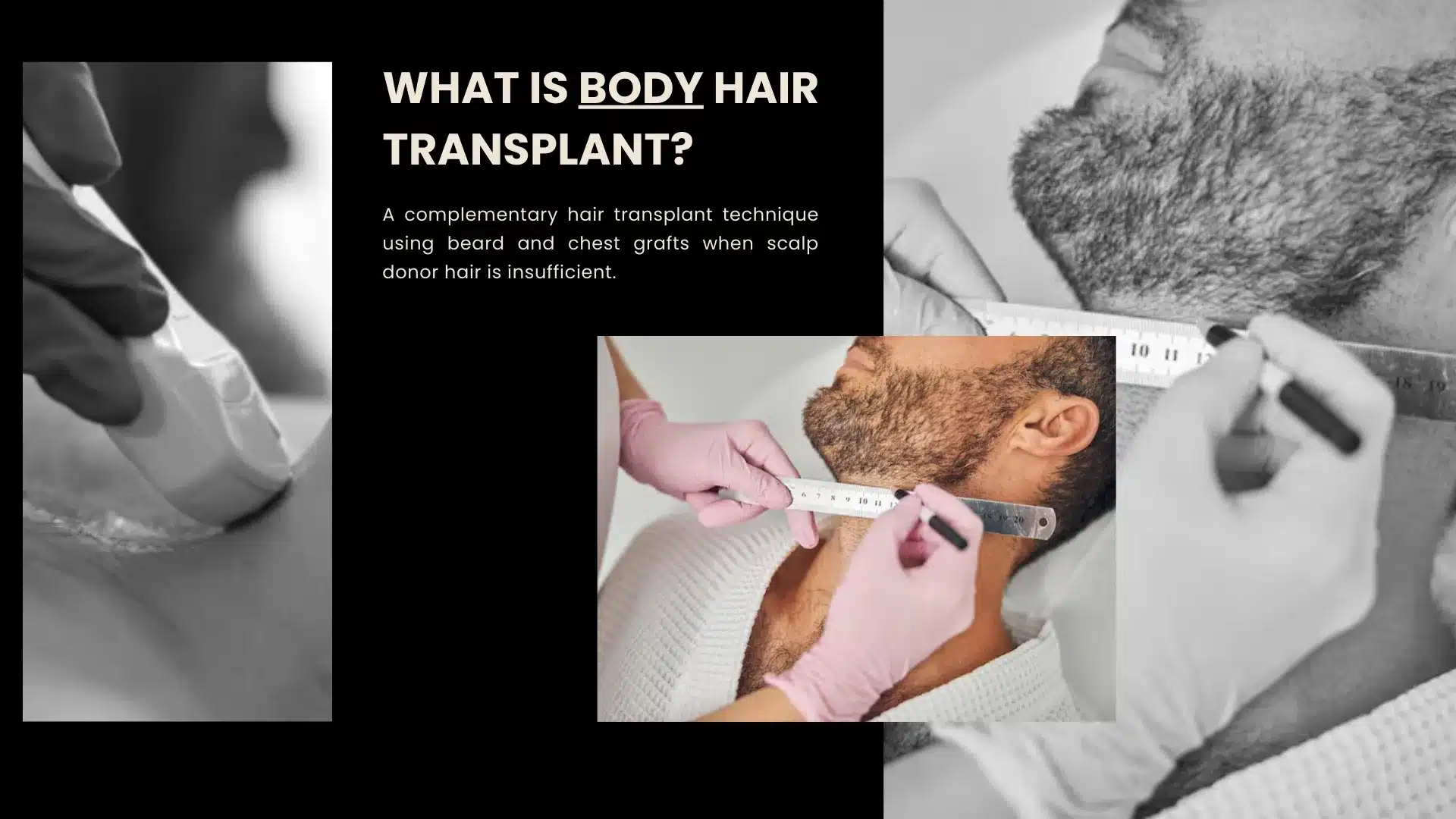 How Body Hair Transplant Works