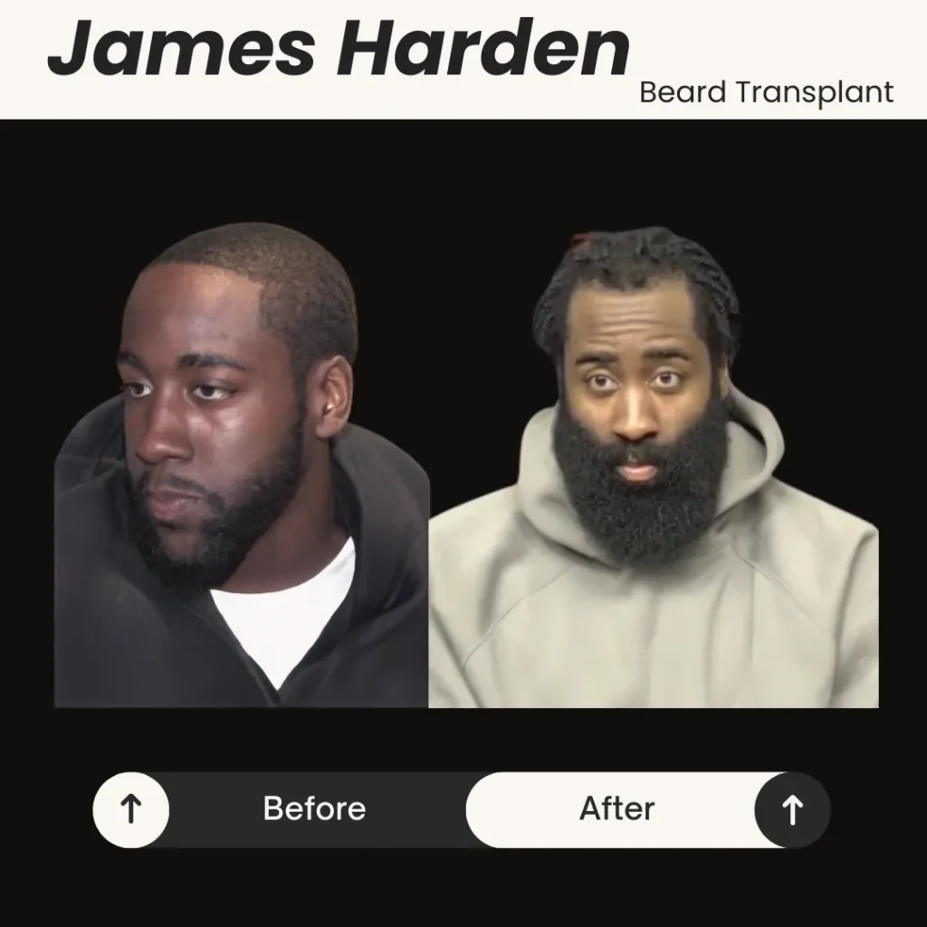 Beard Transplant In Turkey – Cost, Before And After 16 James Harden Before And After Photos Showing Changes In Hairline And Overall Hair Density.