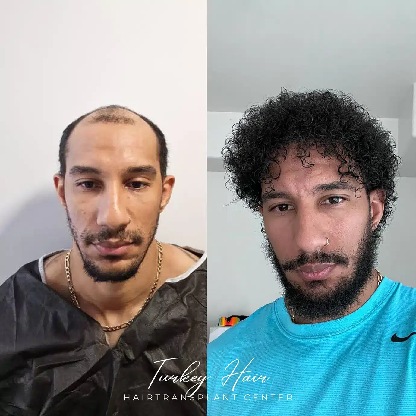 Hair Transplants Patient