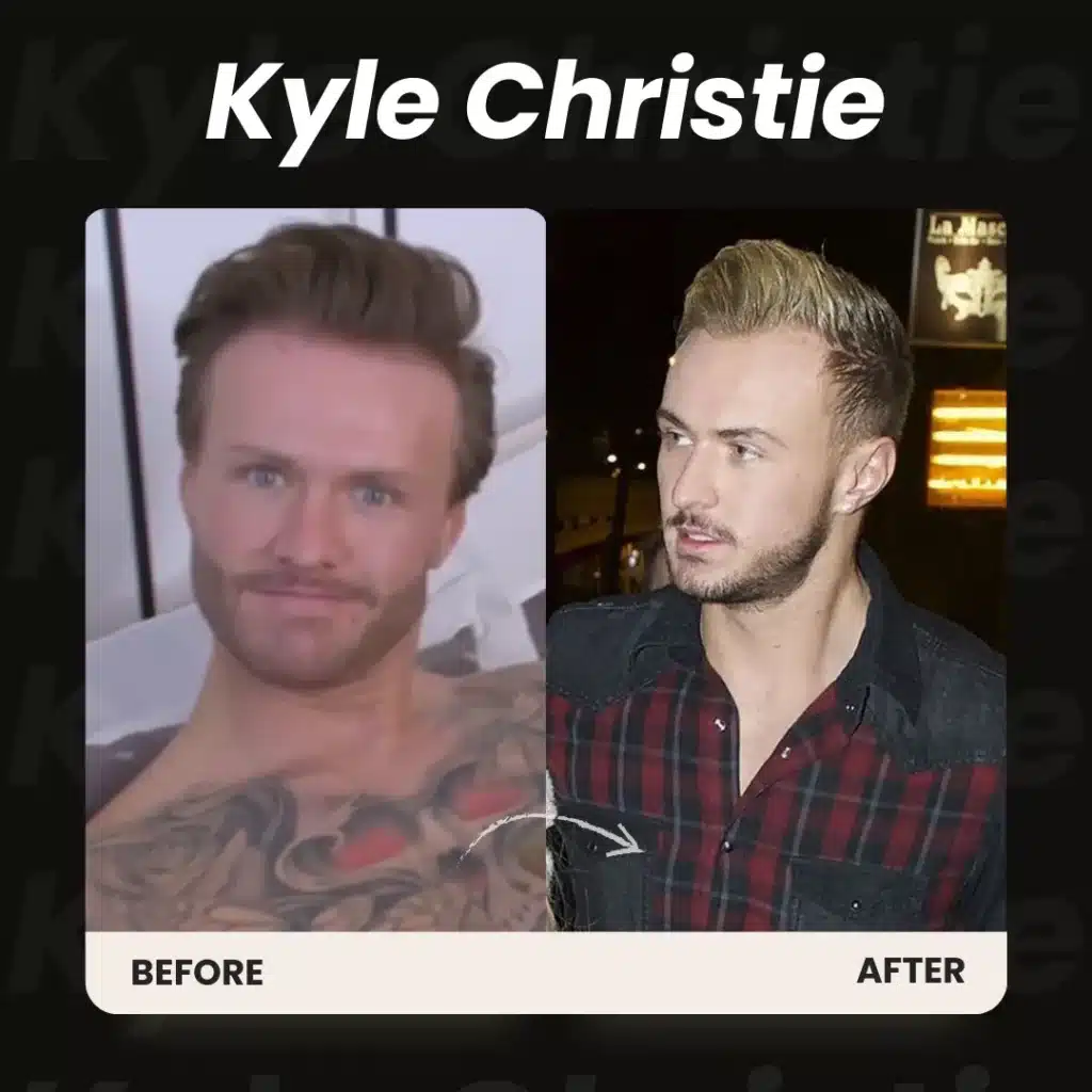 Beard Transplant In Turkey – Cost, Before And After 15 Kyle Christie Beard Transplant Before And After Results Showing Natural Beard Density And Defined Facial Hair Design.