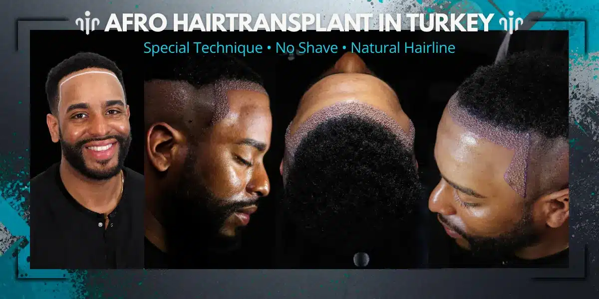Afro Hair Transplant For Curly &Amp; Coily Hair 13 Natural Hairline Is Essential For Achieving Realistic And Aesthetically Balanced Hair Transplant Results.