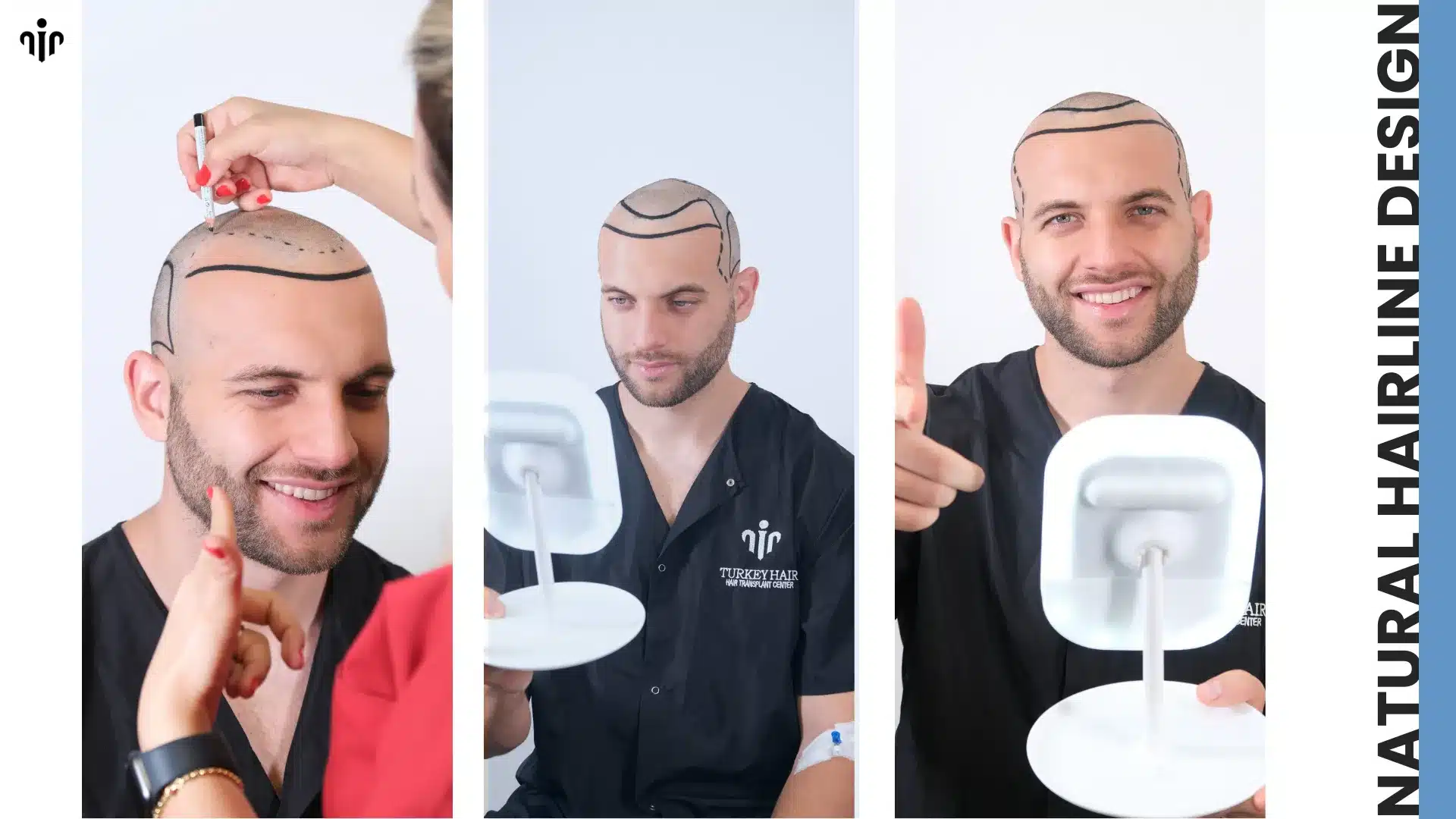 Sapphire Hair Transplant 