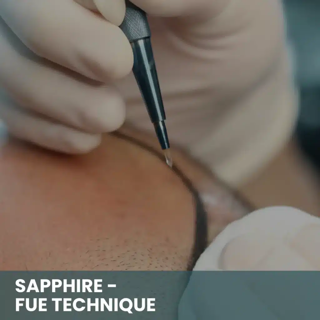 Fue Hair Transplant In Turkey – Cost, Before &Amp; After 11 Sapphire Fue Hair Transplant Procedure