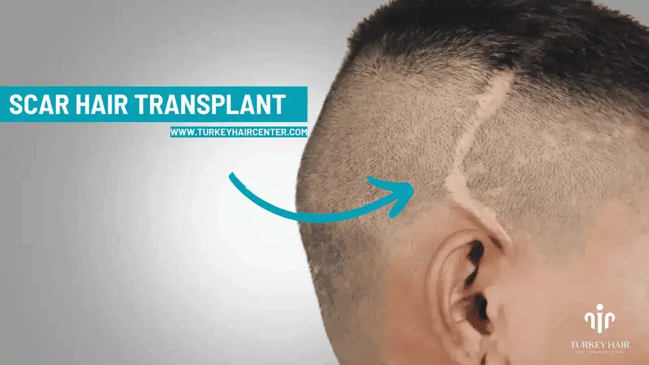 Scar Hair Transplant