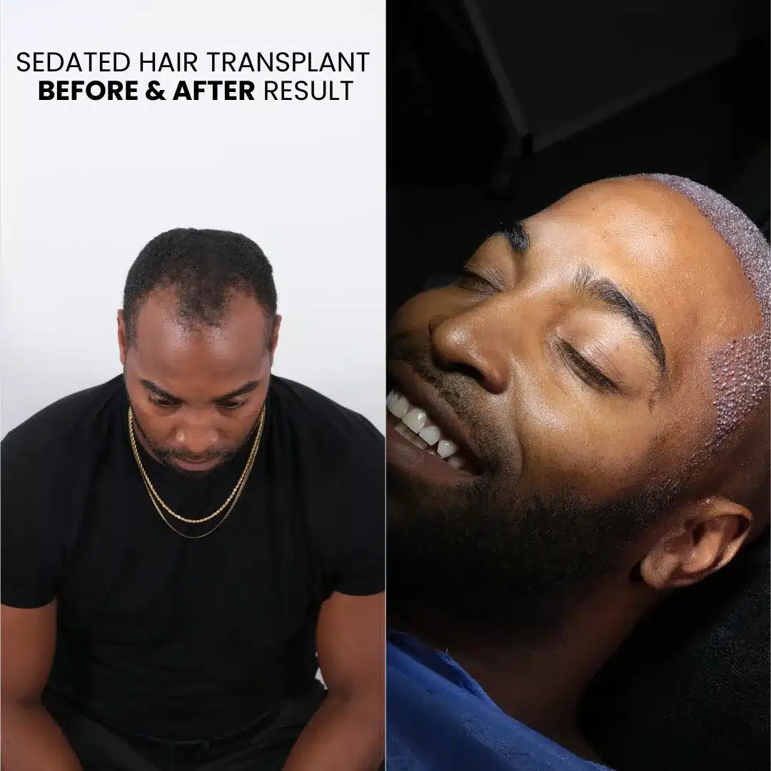 Sedated Hair Transplant Before And After