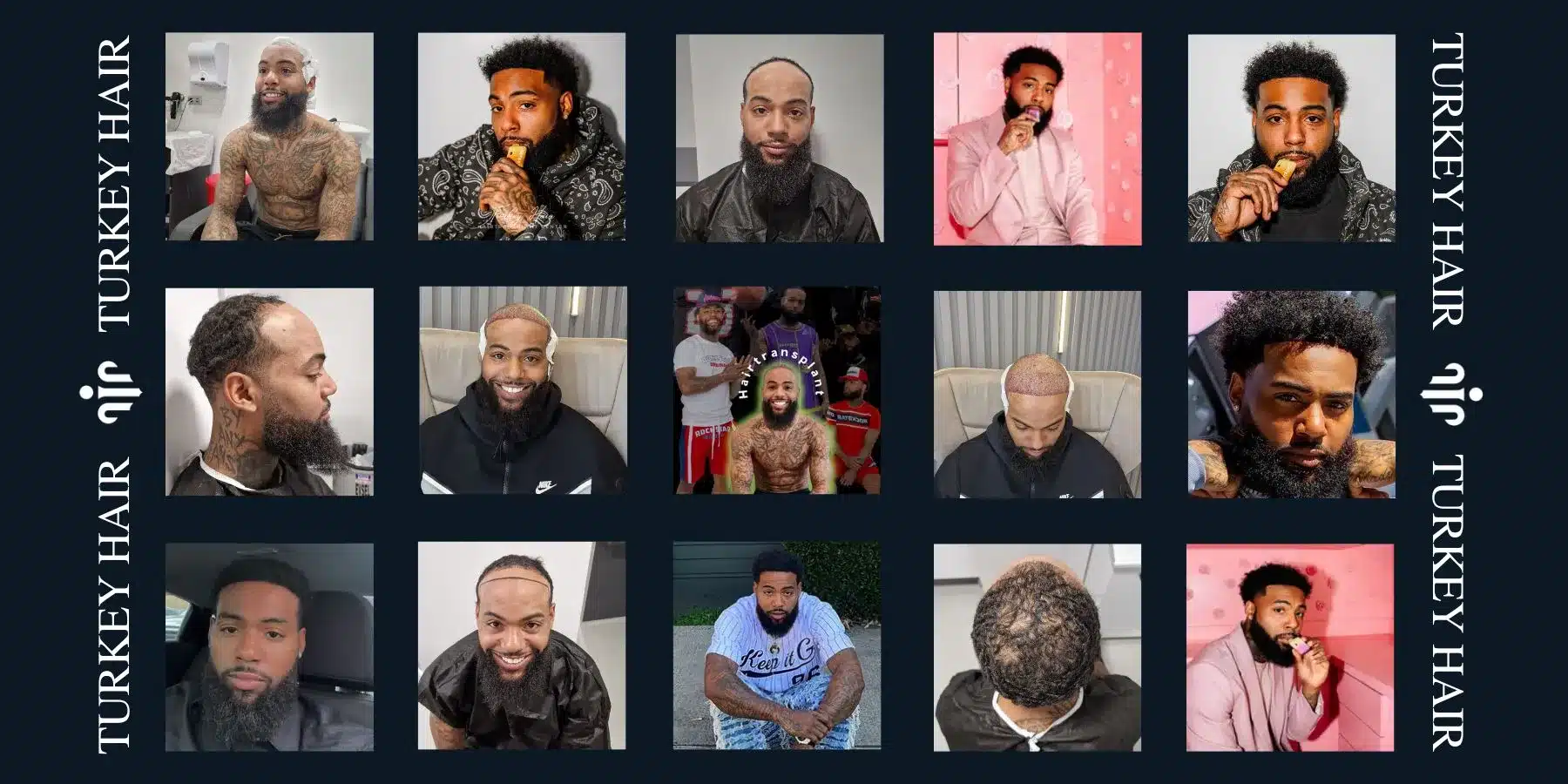 Afro Hair Transplant For Curly &Amp; Coily Hair 16 Begin Your Hair Transplant Journey In Turkey With Expert Care, Advanced Techniques, And A Comfortable Medical Experience.