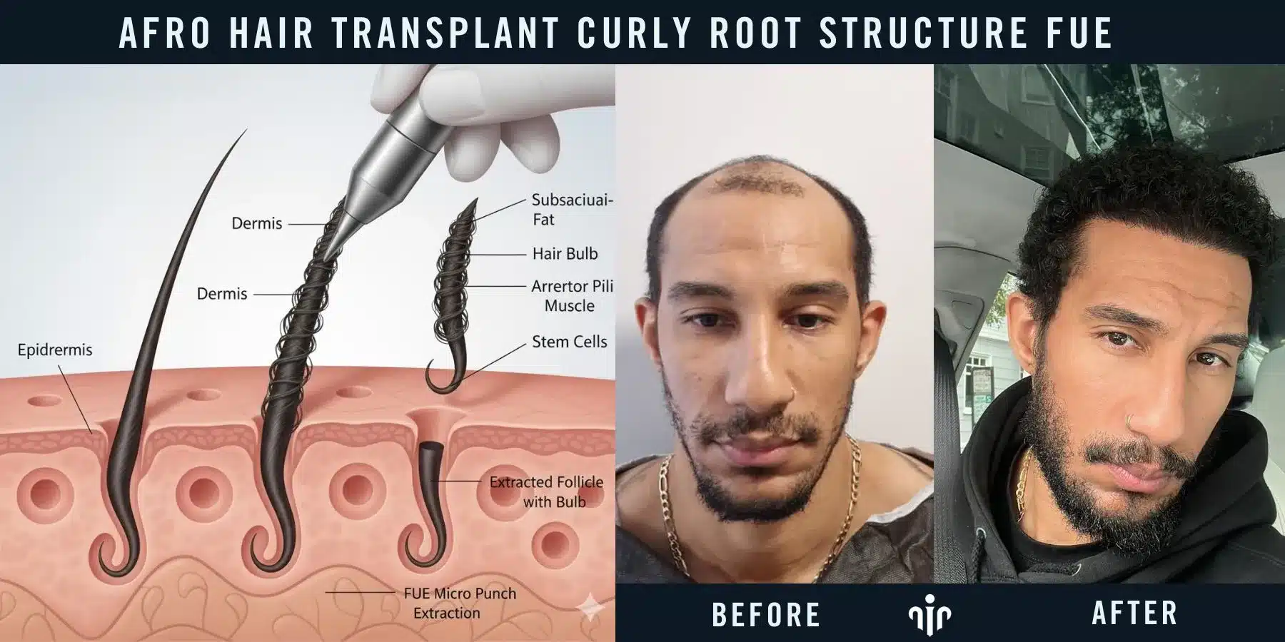 Afro Hair Transplant For Curly &Amp; Coily Hair 4 Curly Hair Roots Have A Unique Curved Structure Beneath The Scalp, Requiring Specialized Techniques During Hair Transplantation.