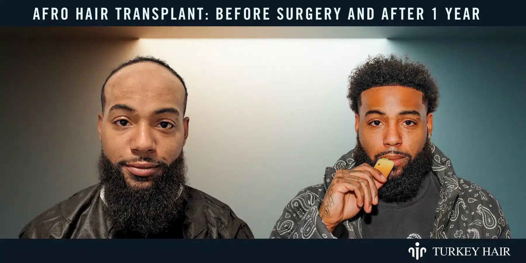 Afro Hair Transplant For Curly &Amp; Coily Hair 6 See The Transformation With Before And After Results, Showcasing Natural Hairline And Improved Density.