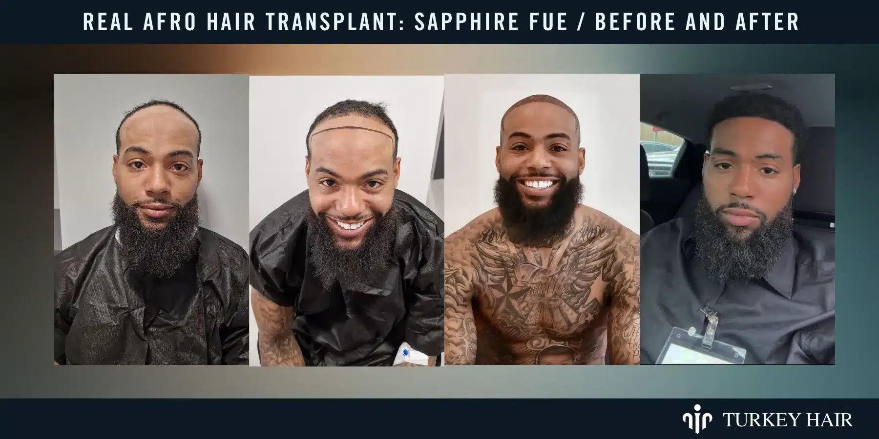 Afro Hair Transplant For Curly &Amp; Coily Hair 10 Sapphire Fue Before And After Results Showing Natural Hairline And Improved Density.