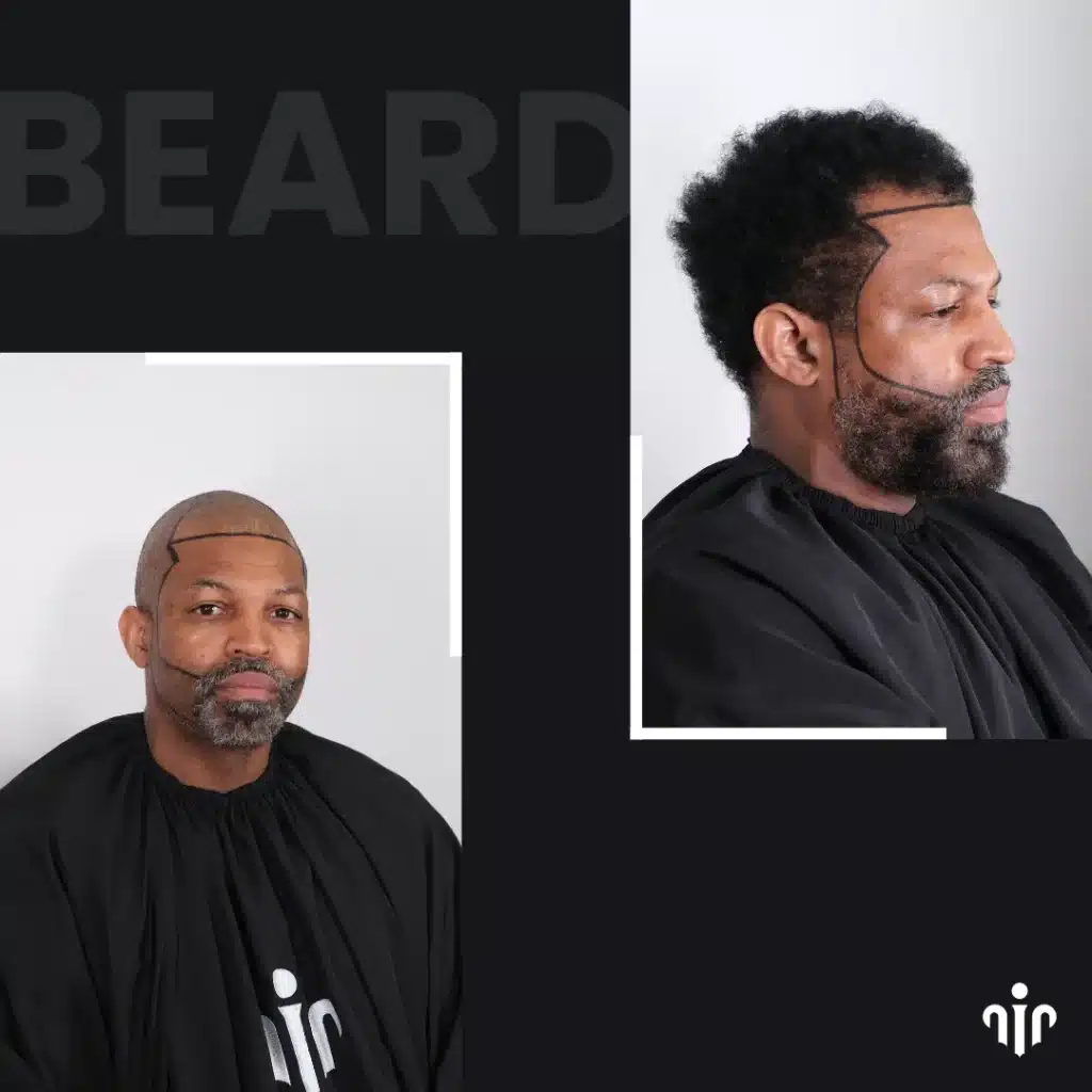 Beard Transplant In Turkey – Cost, Before And After 14 Before Beard Transplant Showing Planned Beard Design Drawn On The Face