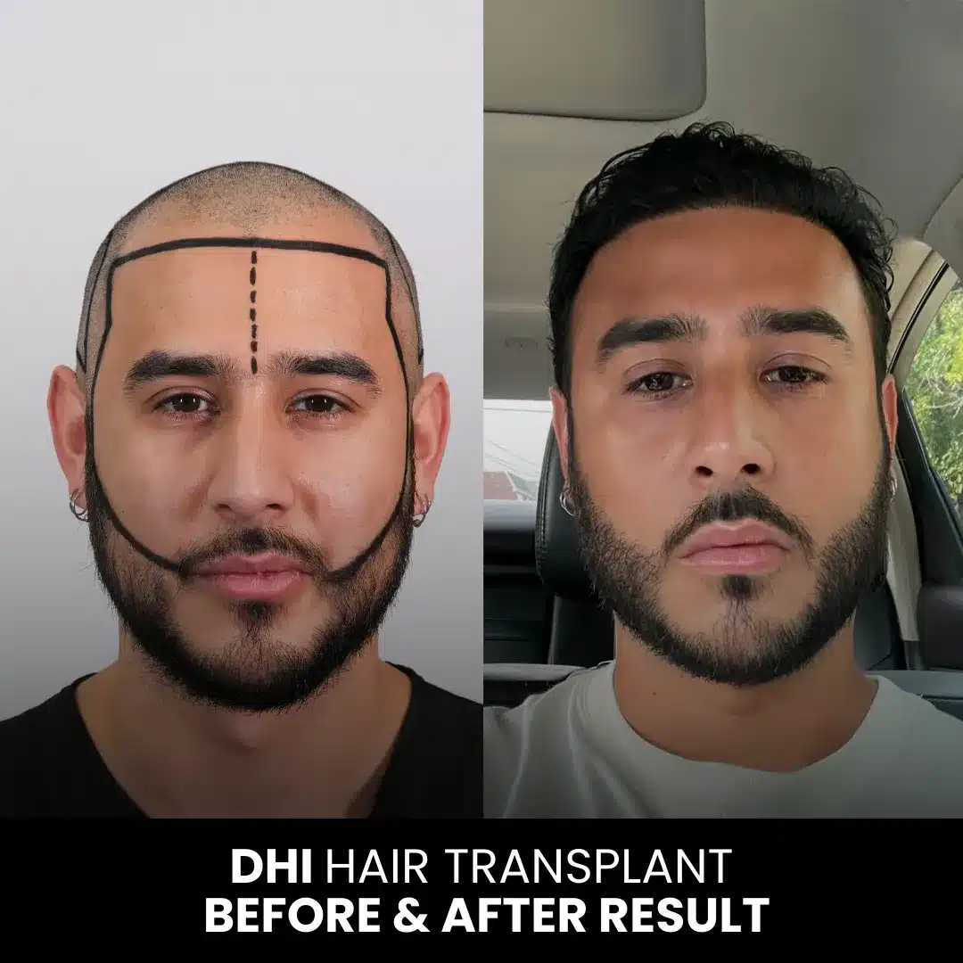 Dhi Hair Transplant 10 Dhi Hair Transplant Before And After