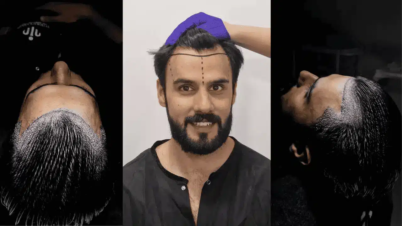 Dhi Hair Transplant