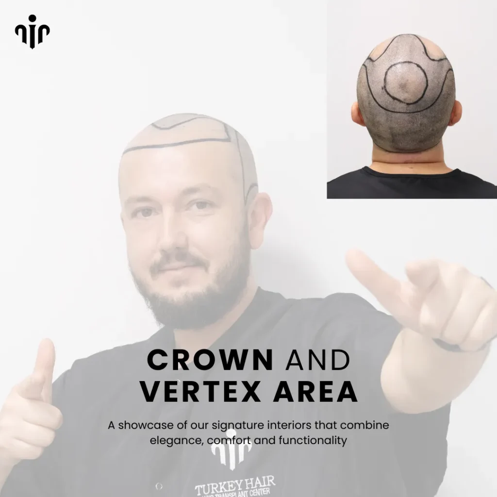 Fue Hair Transplant In Turkey – Cost, Before &Amp; After 12 Hair Transplant In The Vertex And Crown Areas Requires Careful Planning For Natural Density And Growth Direction.