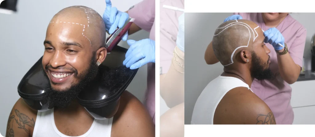 Hair Transplant Before Procedure Preparation And Consultation