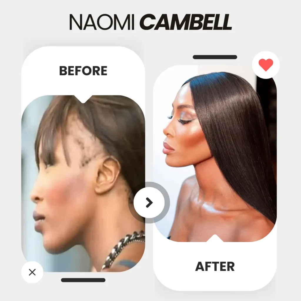 Naomi Campbell Before And After The Hair Transplant 